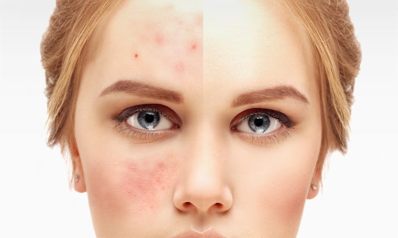 Cuida tu piel! | ¿El maquillaje causa acné? - 800Noticias
