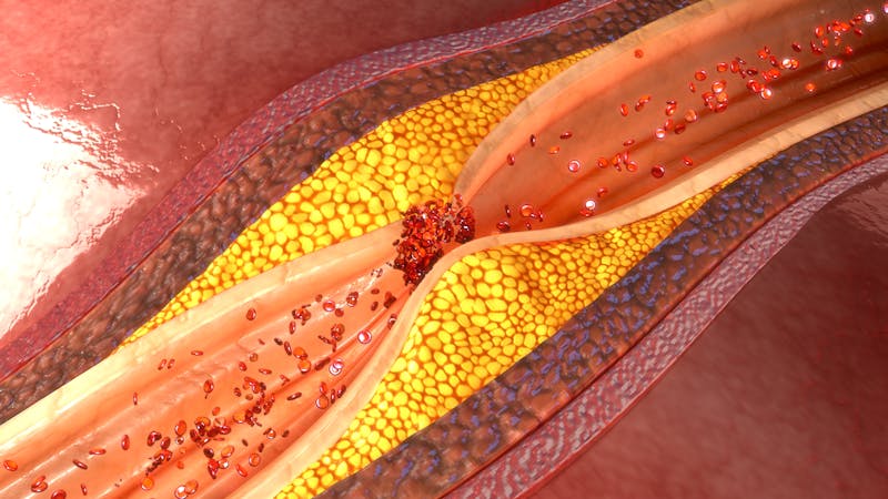 Placa arteria coronaria