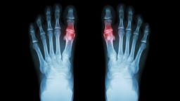 ¿Podemos culpar a la cetosis del rebrote de gota?