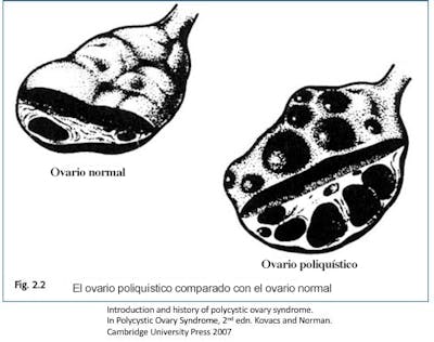 Comparación ovario normal – ovario poliquístico