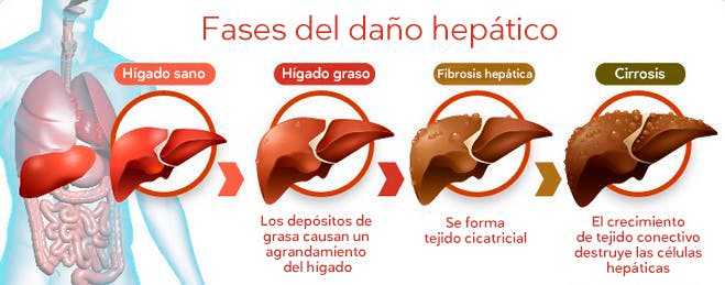 Fases del daño hepático