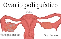 Síndrome del ovario poliquístico e hiperandrogenismo: SOP 7