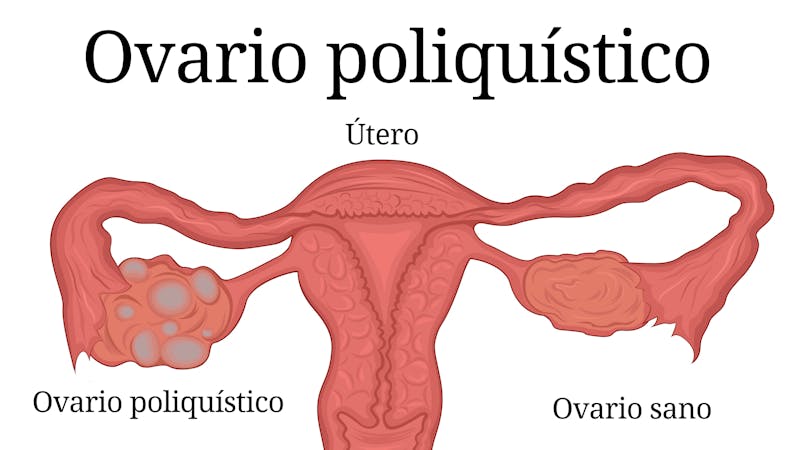 Illustration of Polycystic ovary