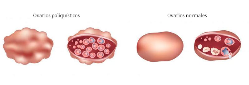 Ovarios poliquísticos