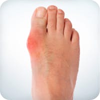 Low carb and gout