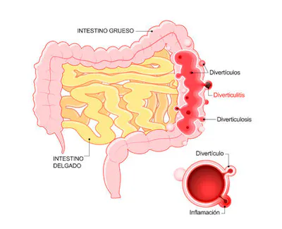 big-diverticulitis-