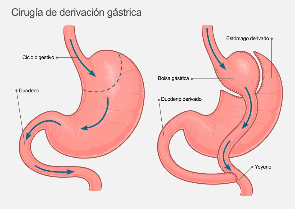 large-derivaciongastrica