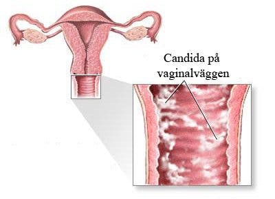 vita prickar i underlivet svamp