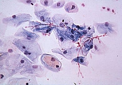 Candidasvamp i mikroskop Candidasvamp i mikroskop