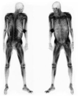 Rhabdomyolys Rhabdomyolys