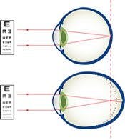 Närsynthet Närsynthet