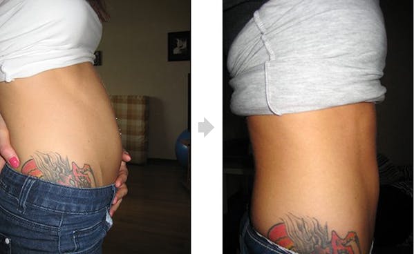 Svullen mage, före och efter kolhydrater Svullen mage, före och efter kolhydrater