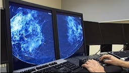 Vanlig blodtrycksmedicin kopplas till bröstcancer