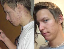 Akne (och IBS) försvann med ändrad kost