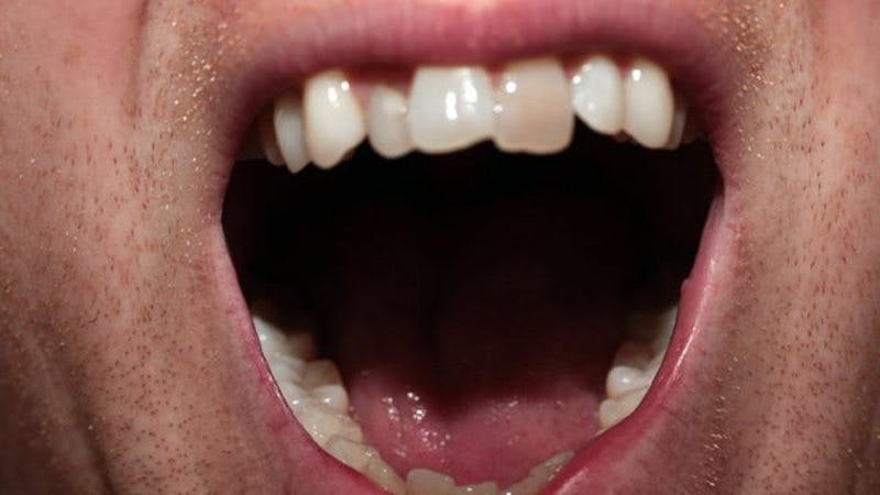 bad-teeth