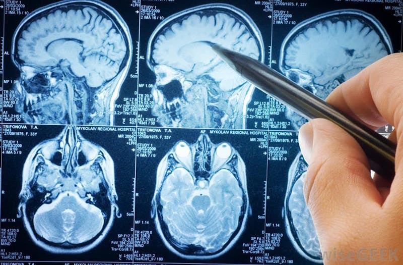 brainscan1