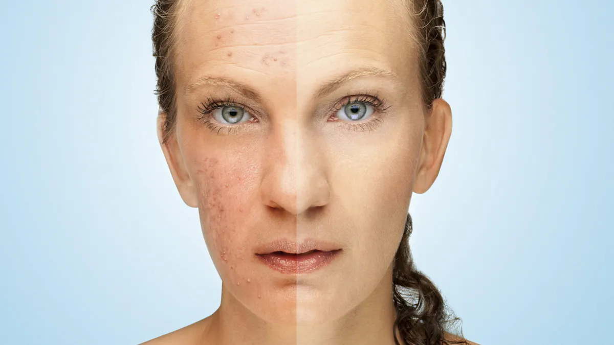 "För första gången på 15 år är jag aknefri"