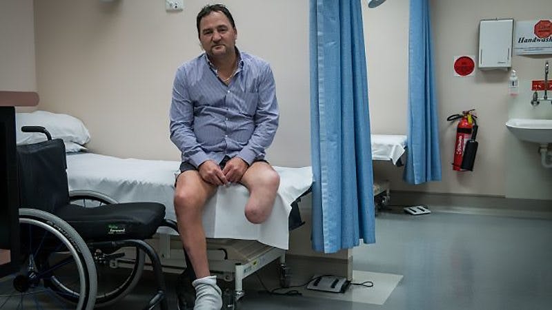 amputations