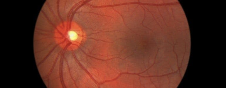 retinopathy-770x300