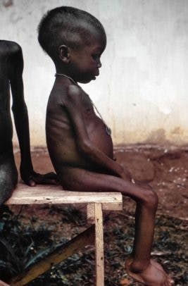 kwashiorkor-267x406