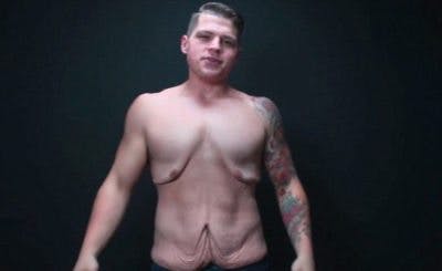 loose-skin-after-weight-loss-652x400-1-1465991756-400x245