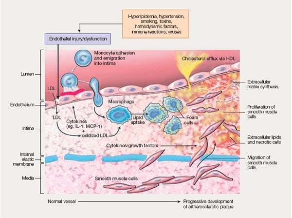 atherosclerosis