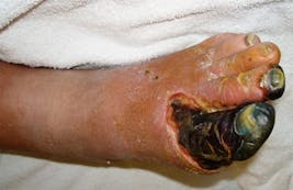 gangrenousfoot