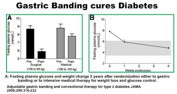 SurgeryCuresDiabetes5
