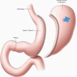 SleeveGastrectomy