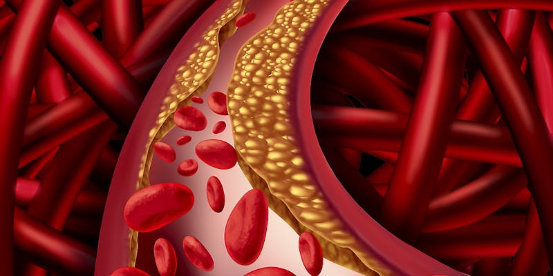 Artery Disease