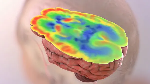 Ny studie: Alzheimers sjukdom kan vara en form av diabetes