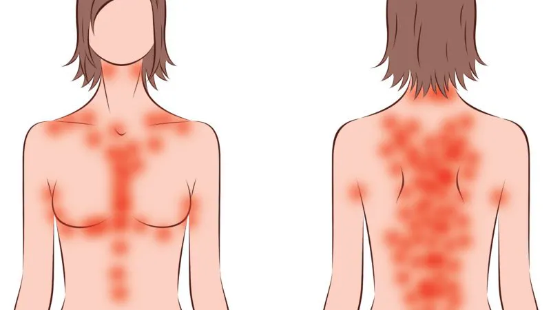 Ketosutslag – varför vissa får det och vad man kan göra åt det