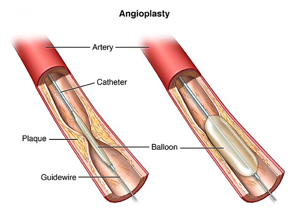 An inserted balloon catheter inflates to open blocked blood vessel