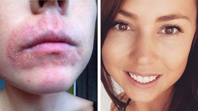 Kan ketogen kost bota hudproblem?