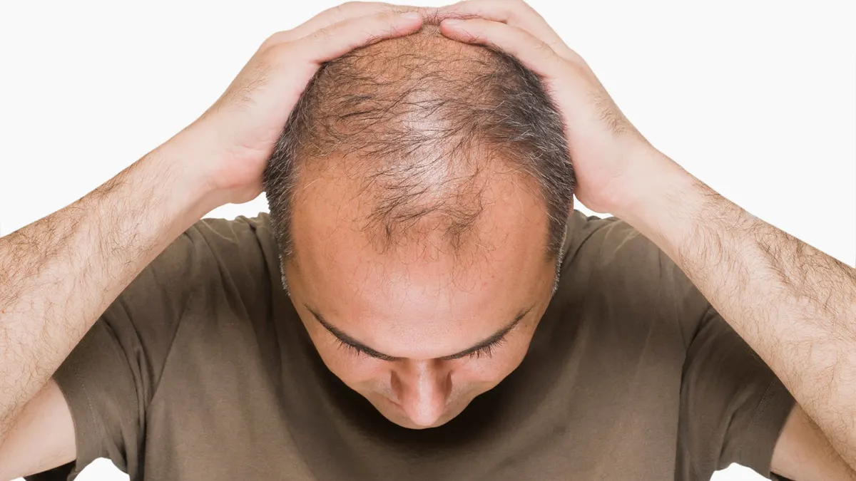 Orsakas manligt håravfall av förhöjt insulin?