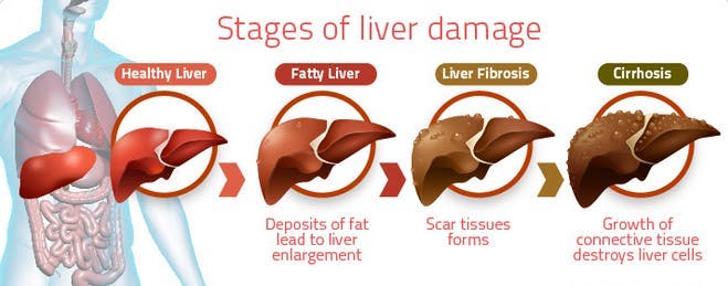 stages-of-liver-damage.png
