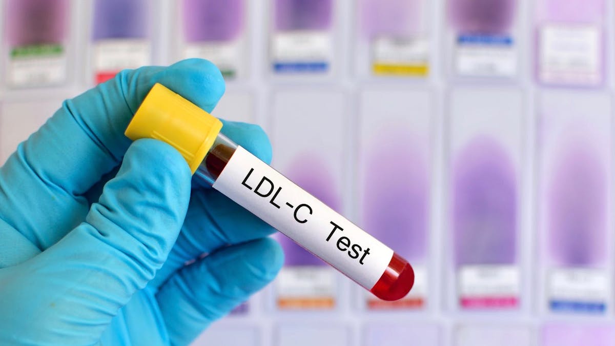 Ny studie: Kan högt LDL vara ett skydd mot demens?