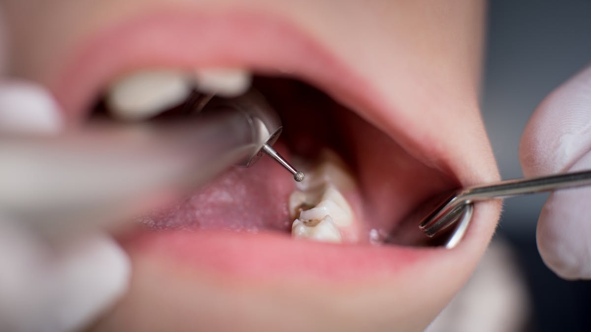 Tandläkare: Nolltolerans mot socker för barn under två år