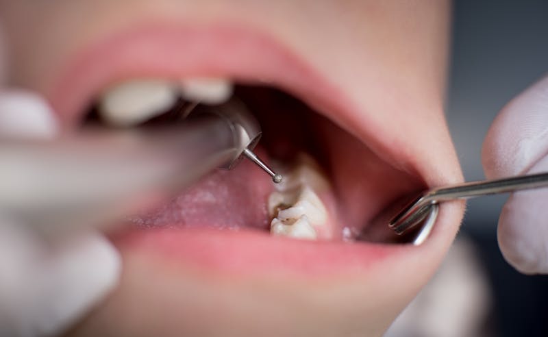 Open mouth during drilling treatment at the dentist in dental clinic. Close-up. Dentistry