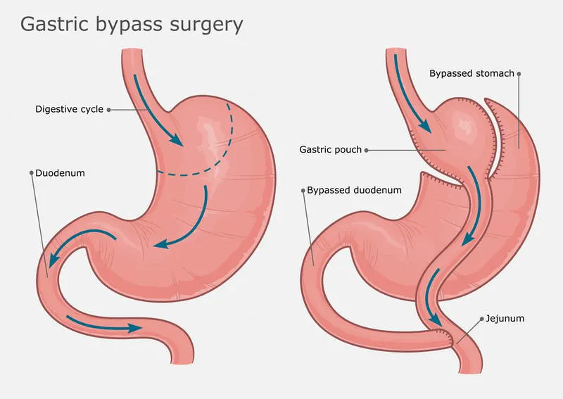 gastric-bypass-surgery