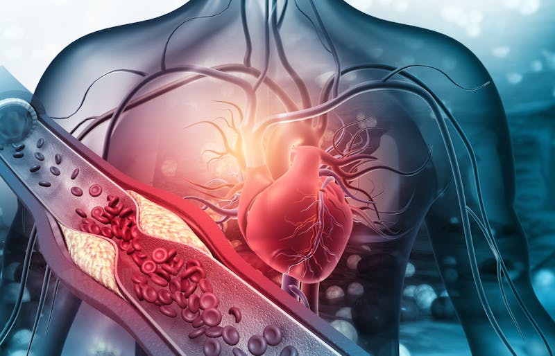 Human heart with blocked arteries