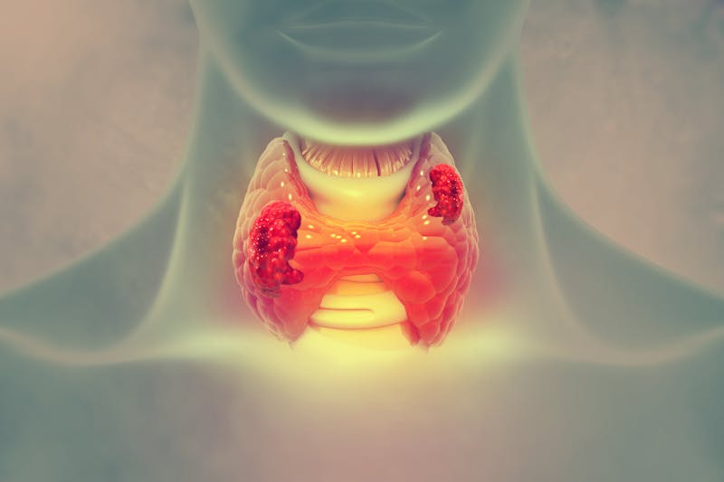 Thyroid gland cancer. showing thyroid gland with tumor. 3d illustration