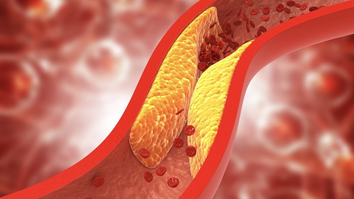 Hur ser sambandet ut mellan högt LDL och kärlskador?