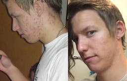 Acne (and IBS) vanished with a diet change