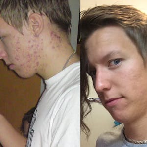 Acne (and IBS) vanished with a diet change