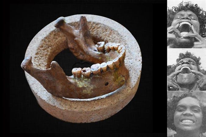 No need for braces before agriculture