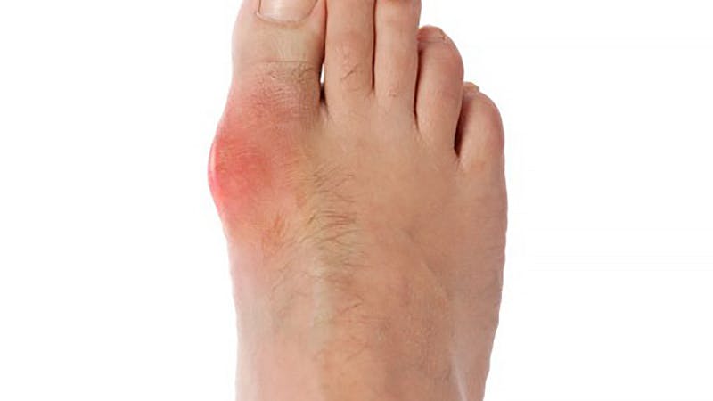 Gout and low carb