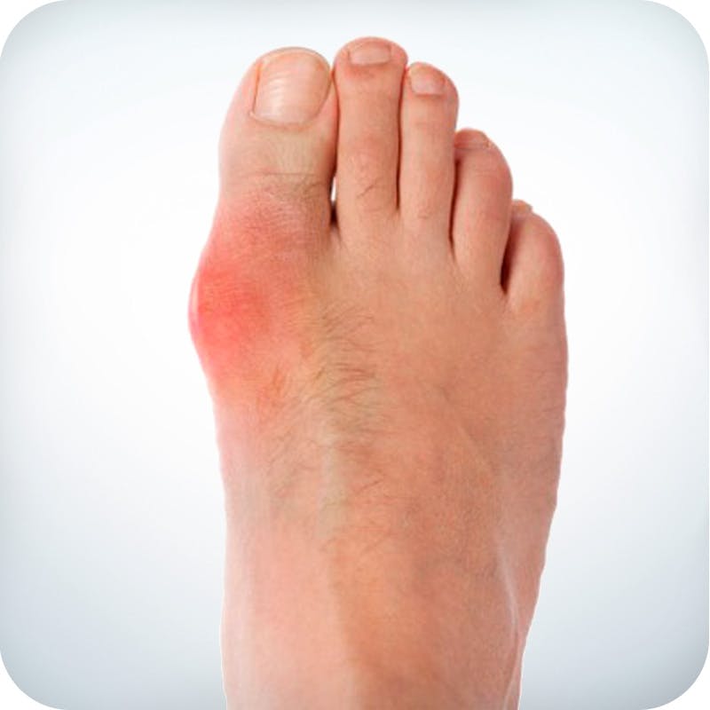 Gout and low carb