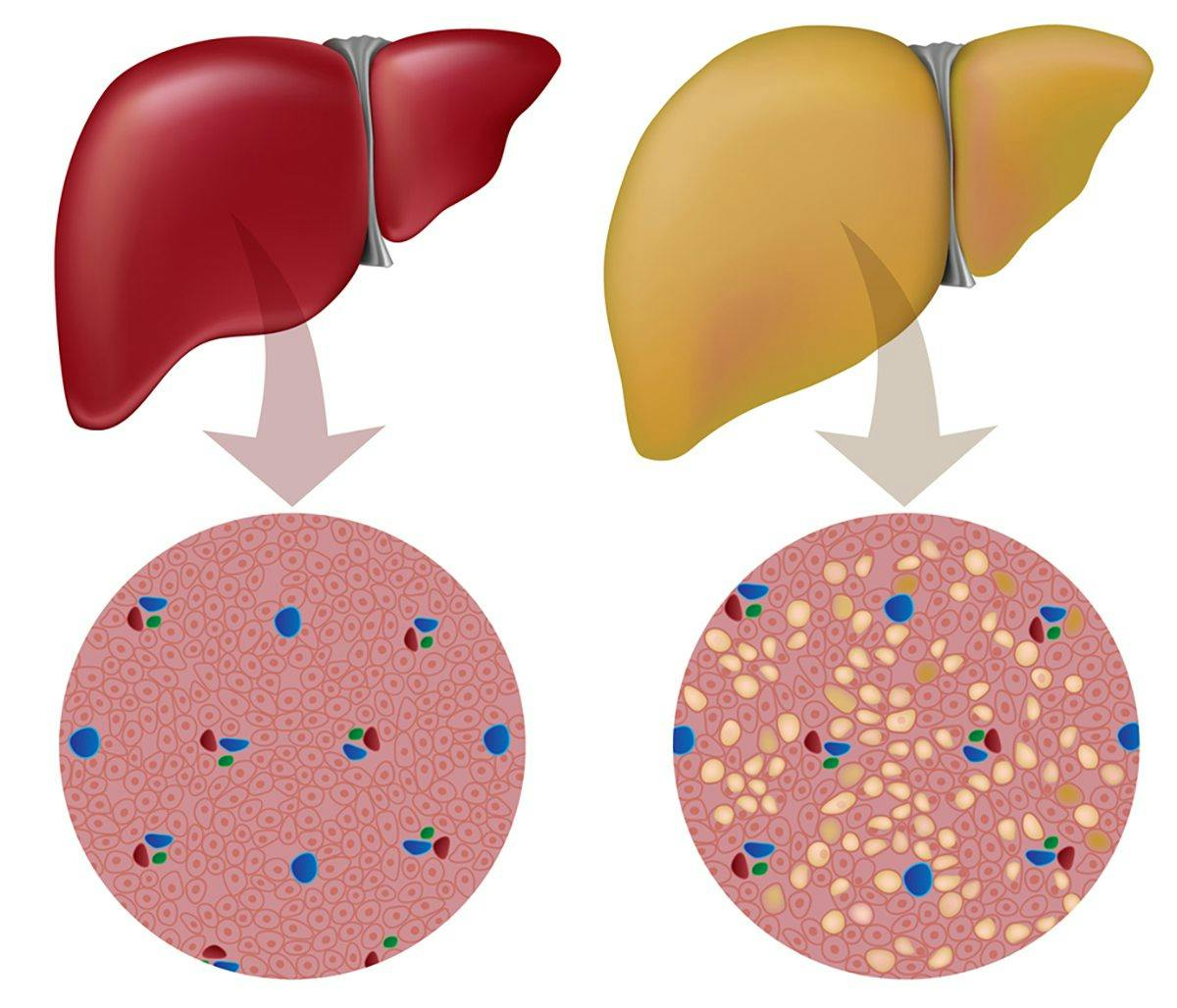 Healthy vs Fatty Liver