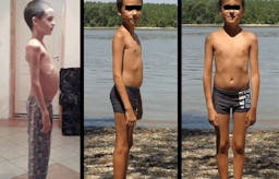 A child with type 1 diabetes successfully treated with the paleolithic ketogenic diet